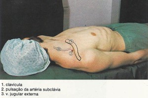 Anestesia-supraclavicular