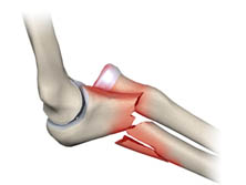 Patologias do Cotovelo - Fraturas