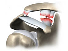 Luxação acrômioclavicular