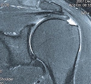 Lesão do Manguito Rotador - Imagem