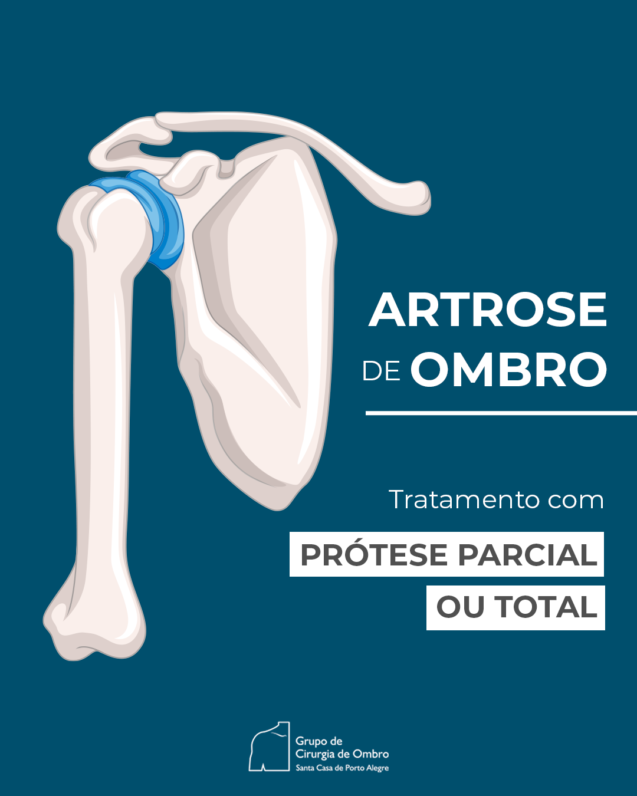 Artrose de Ombro: Tratamento com prótese parcial ou total