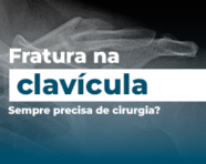 Fratura na clavícula: Sempre precisa de cirurgia?